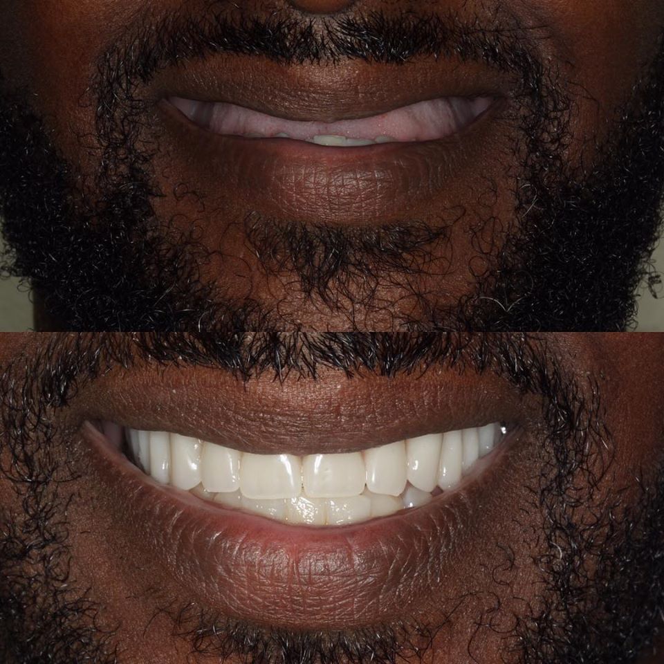 dental implant treatments before and after