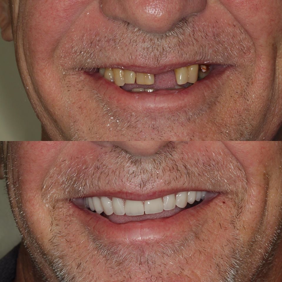 Denture treatments before and after