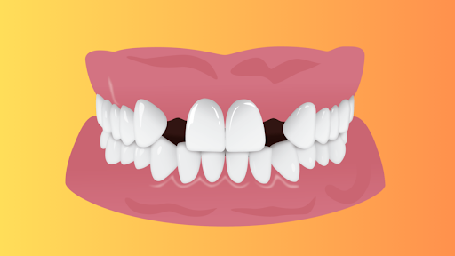 What Is Hypodontia? Causes And Treatments For Missing Teeth