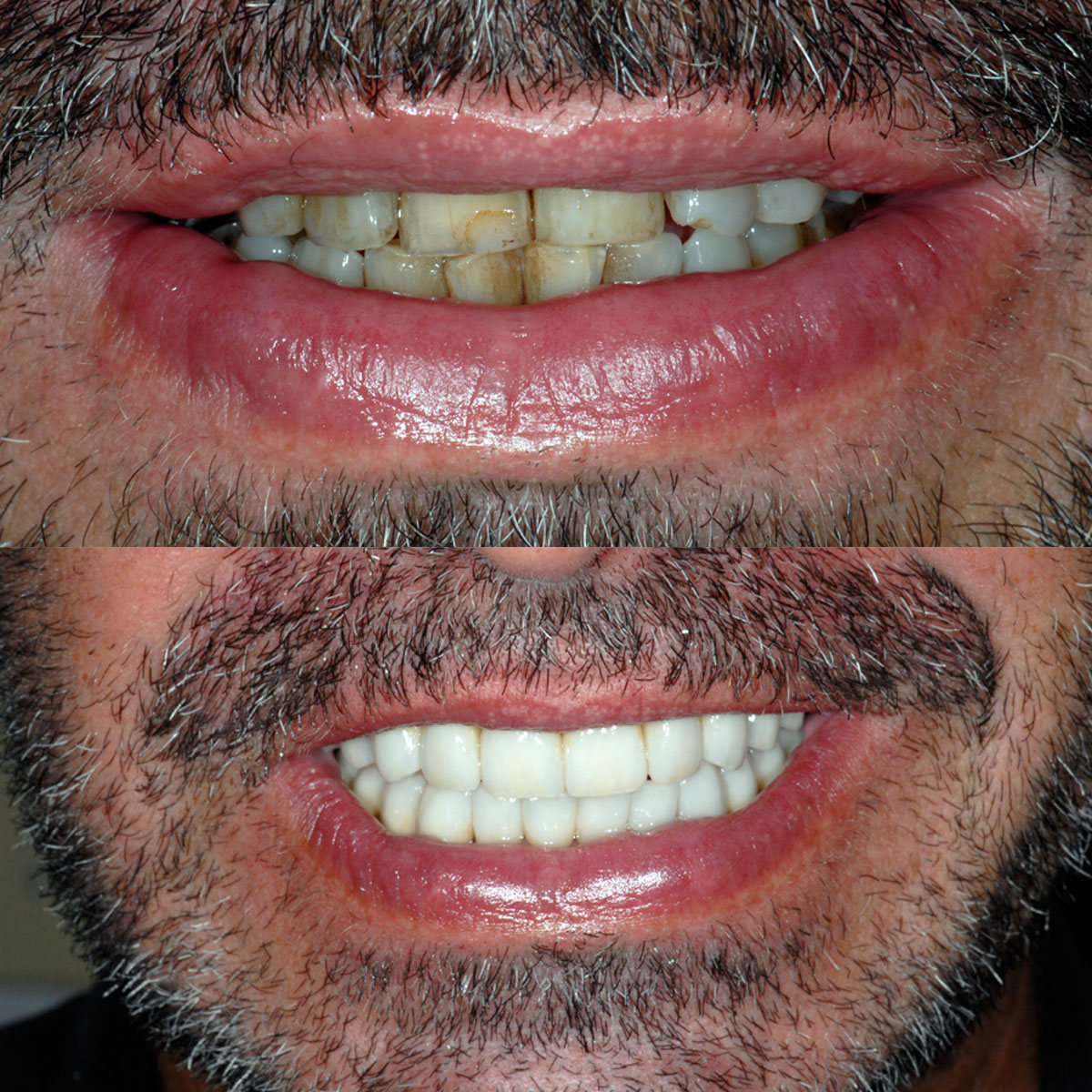 Full-Mouth Dental Implant