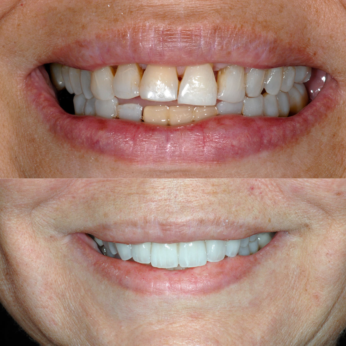 Full-Mouth-Implant- Before After