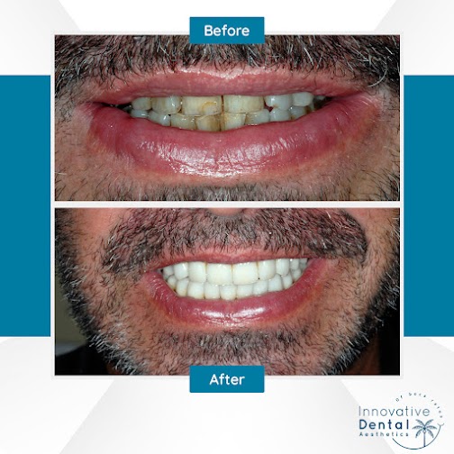 Patient broken smile Before After Result