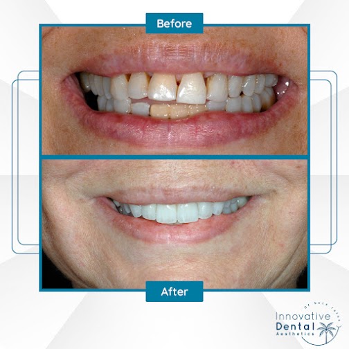 Patient teeth gap before and after image