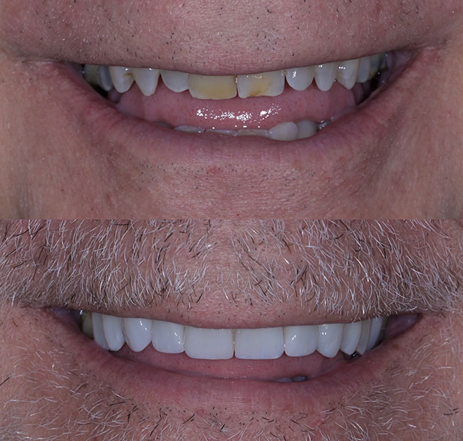 Porcelain Veneers Patient Before and After - Patient Result 1