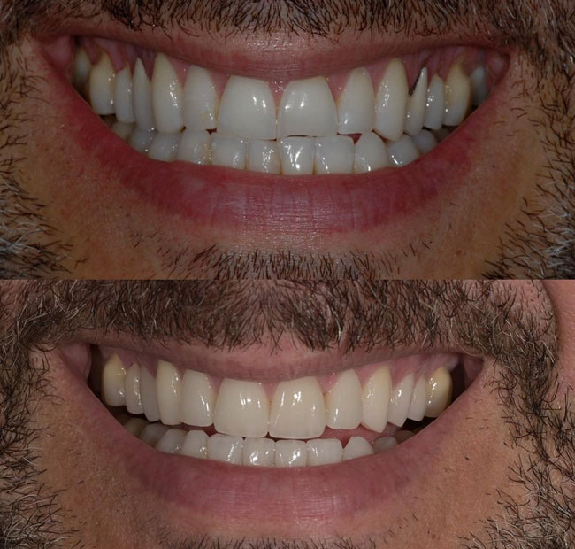 Porcelain Veneers Patient Before and After - Patient Result 2