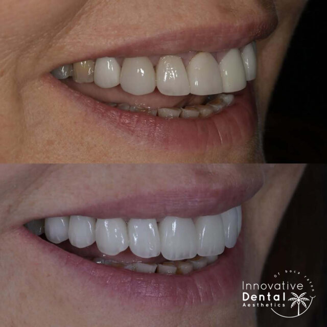 Perfect Smile with Front Tooth Crowns